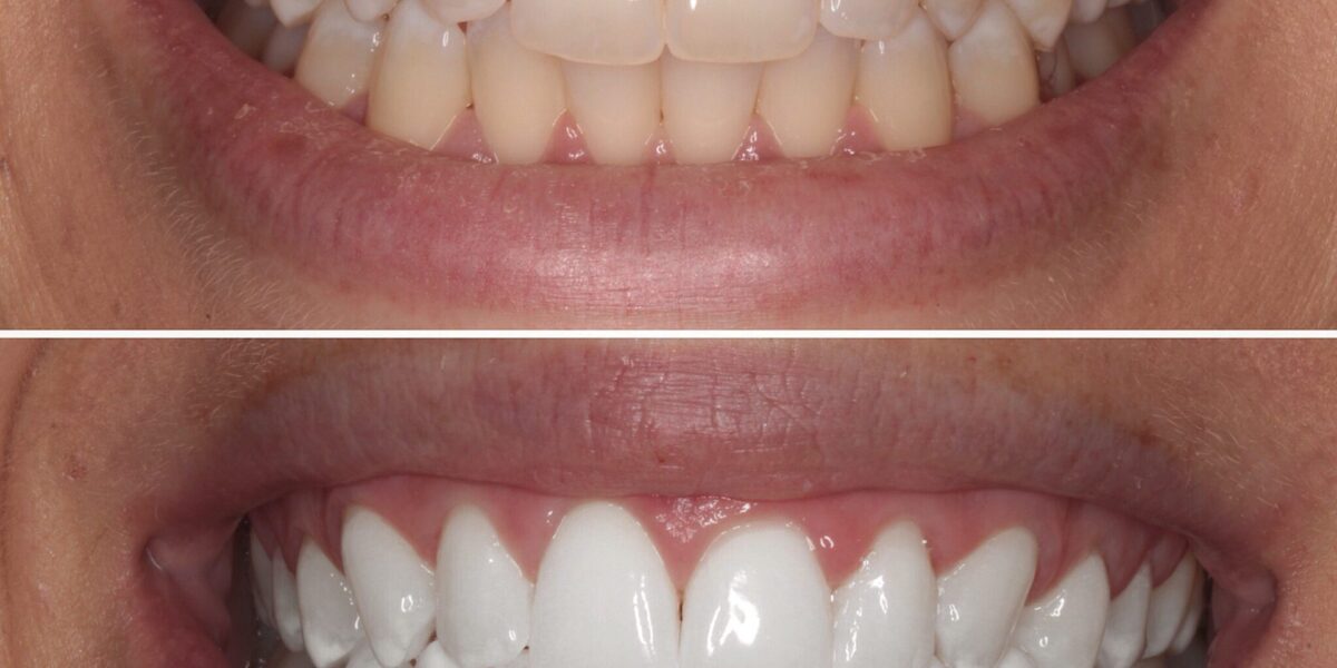 teeth whitening before and after